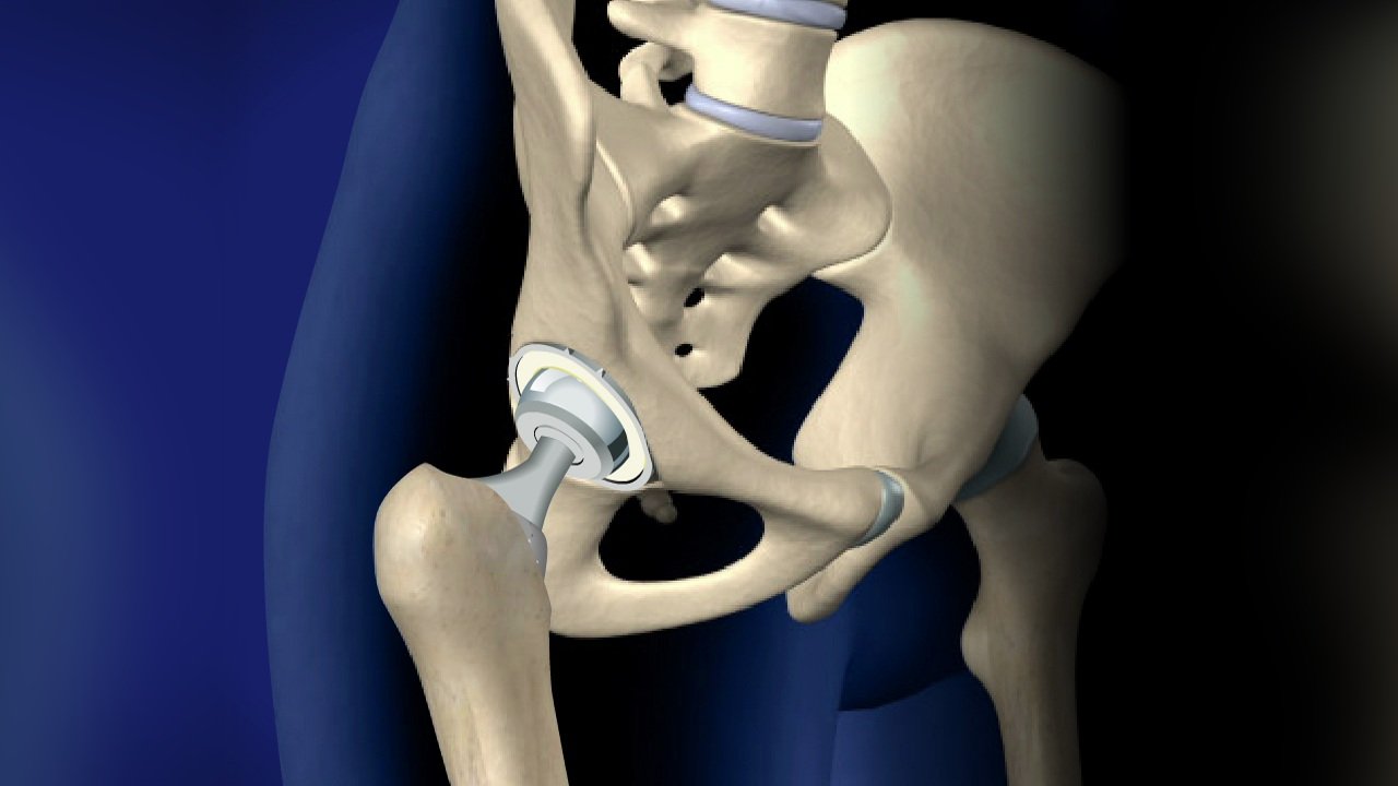 Hip Replacement