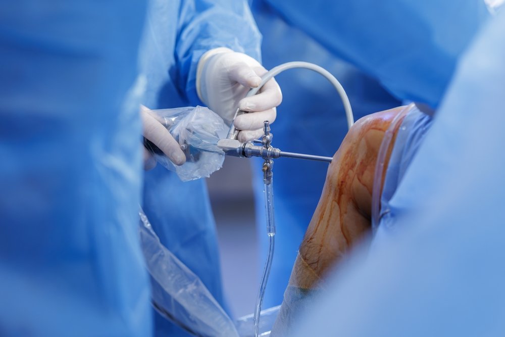 Arthroscopy