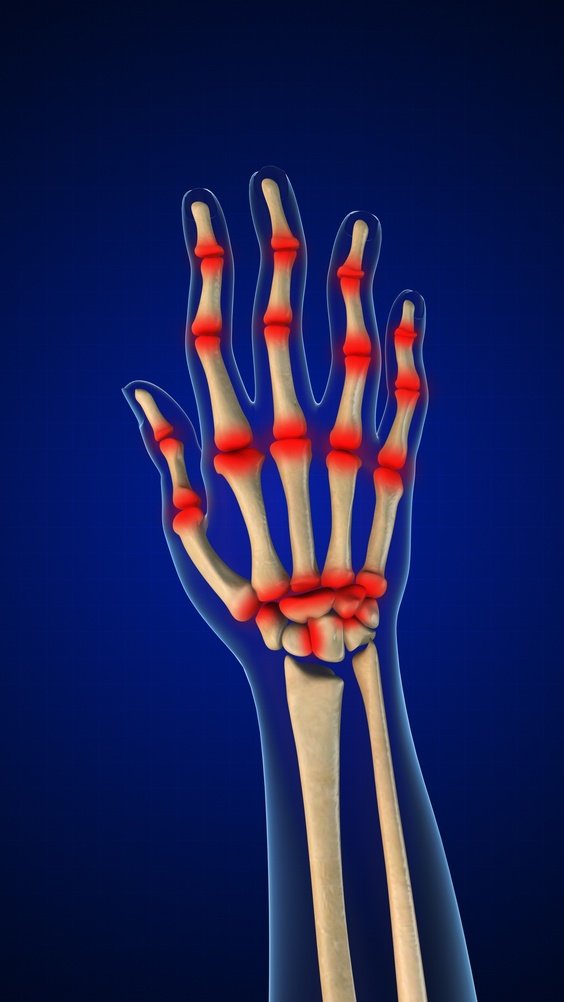 Arthritis Treatment