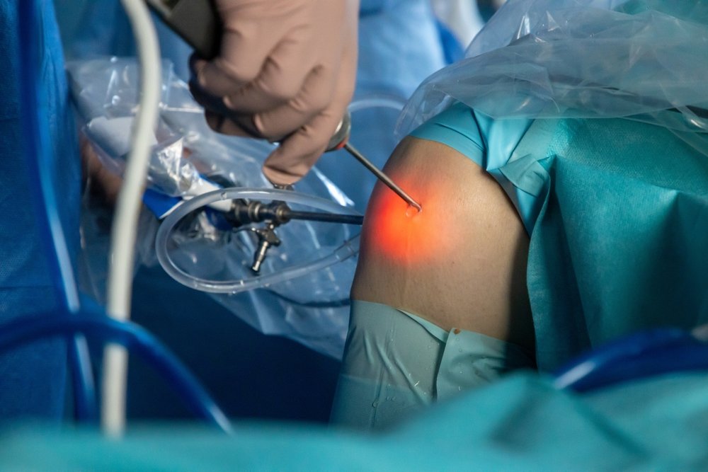 Arthroscopy
