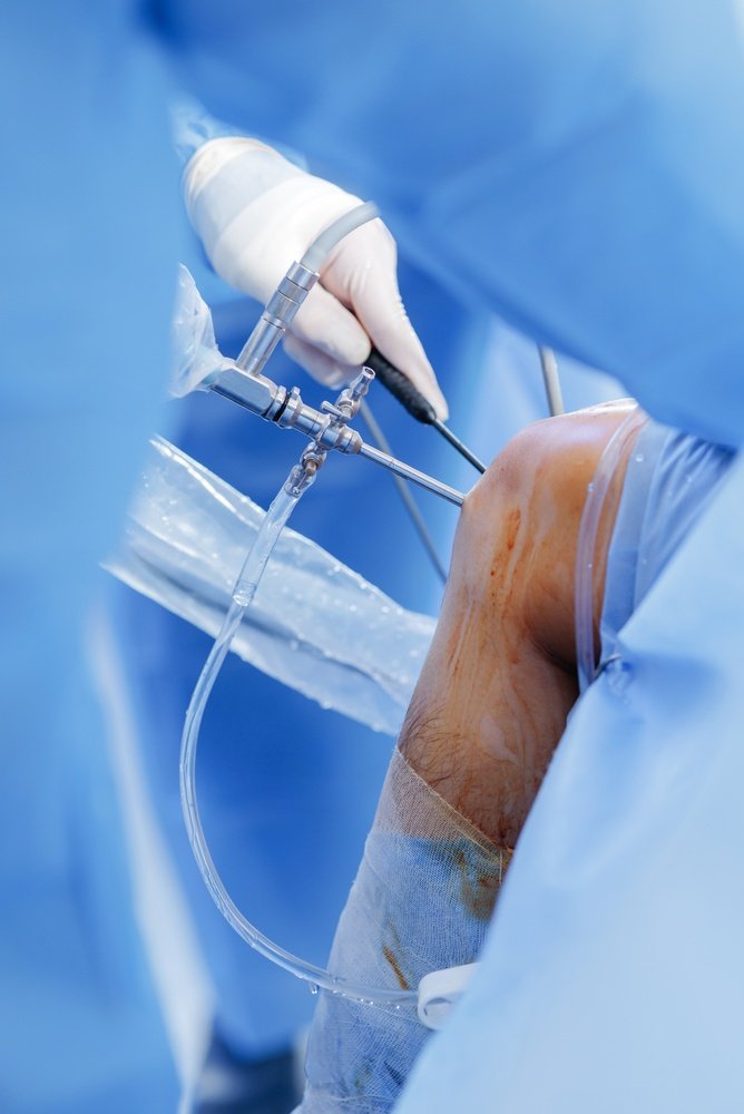 Arthroscopy