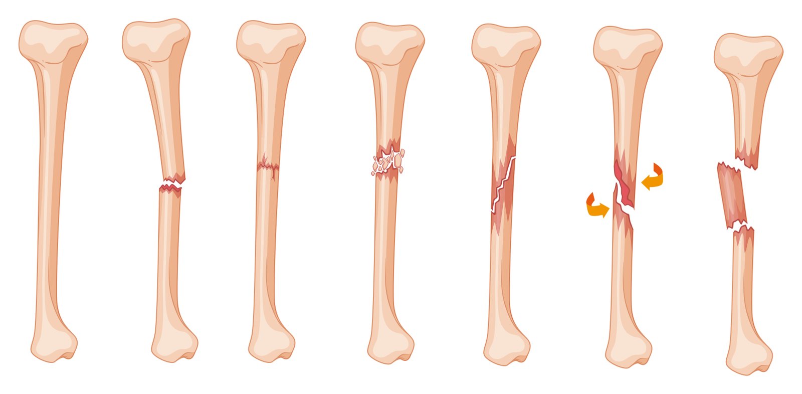 Fracture and Bone Injury Treatment