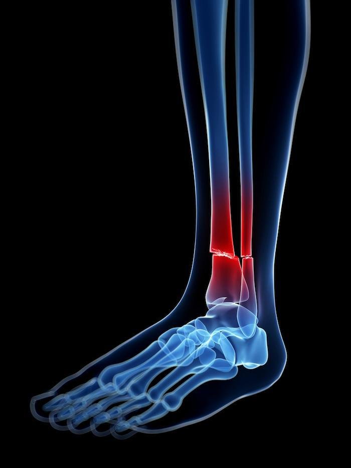Fracture and Bone Injury Treatment