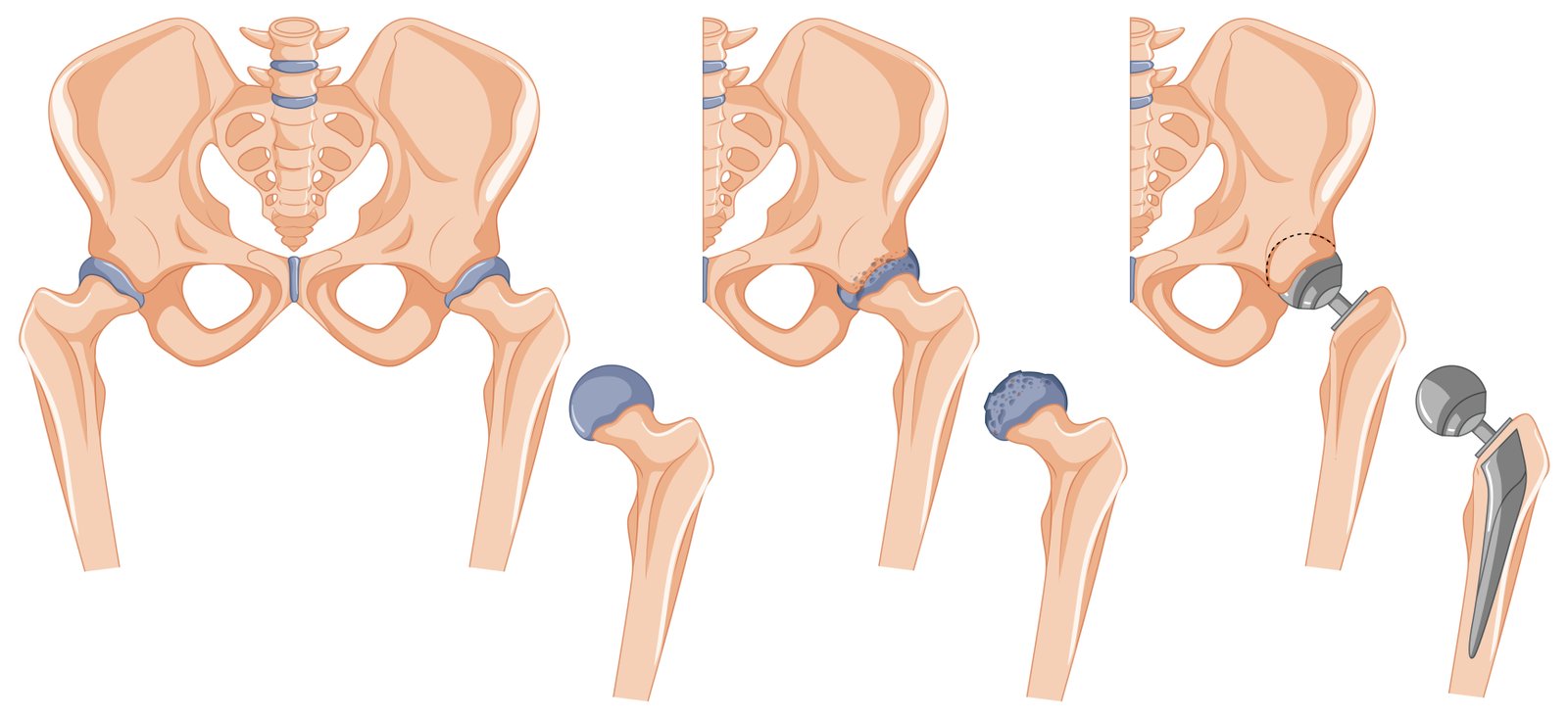 Hip Replacement