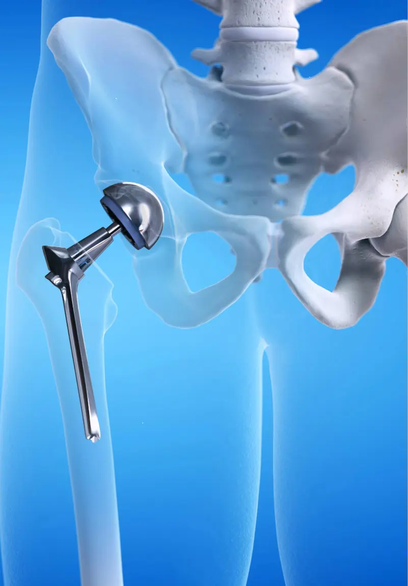 Hip Replacement