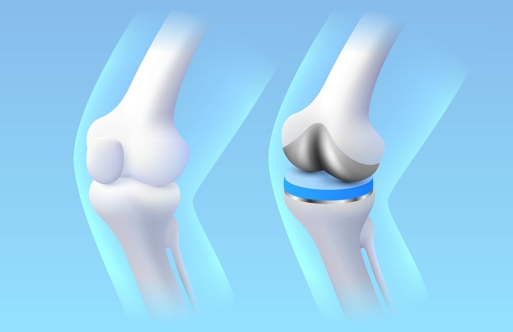 Knee Replacement