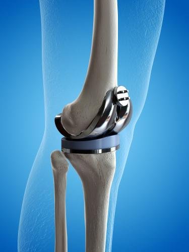 Knee Replacement